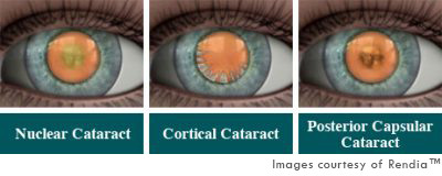 posterior subcapsular cataract