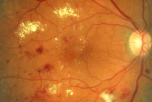 dot and blot hemorrhages