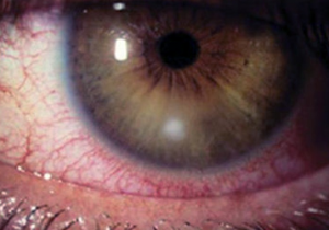 corneal ulcer scar