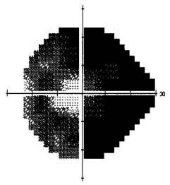 How To Interpret Visual Fields Most Common Patterns Eyeguru