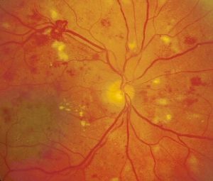 How To Diagnose And Manage Diabetic Retinopathy Eyeguru