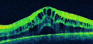 macular edema oct