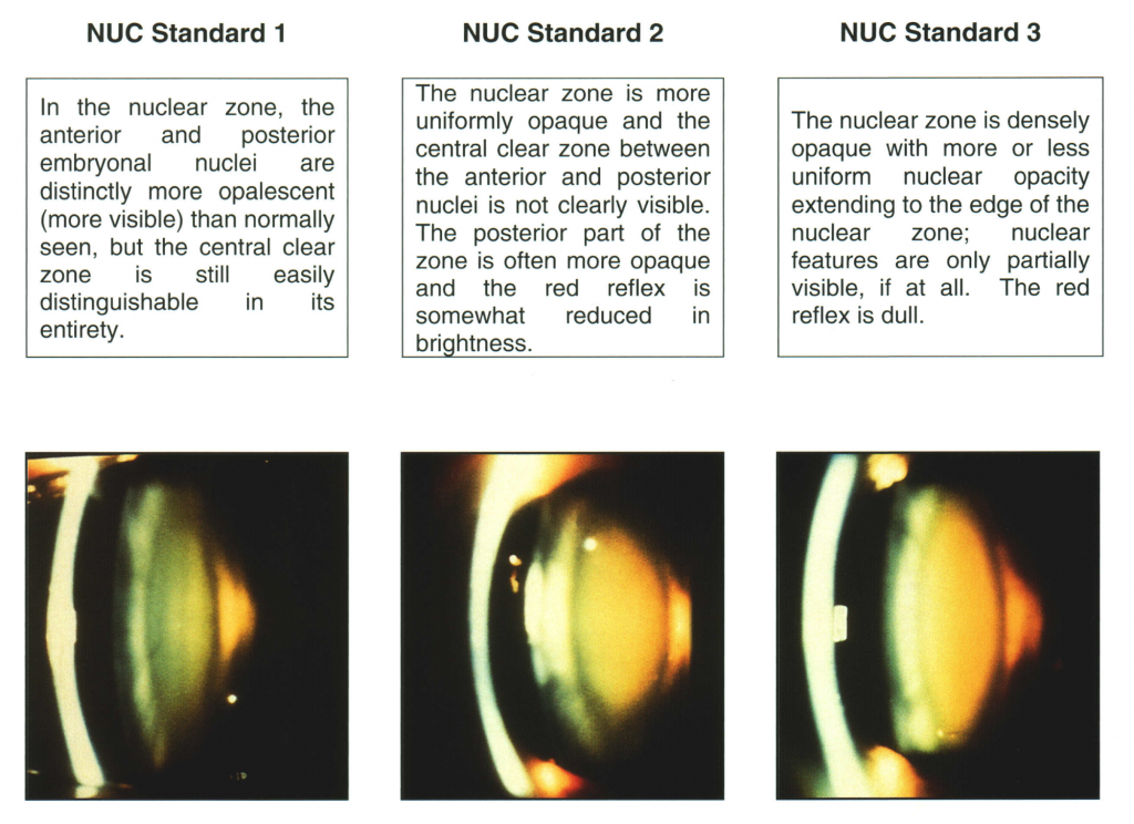 how-to-diagnose-and-grade-cataracts-eyeguru