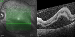 Retinal detachment