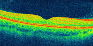 Normal retina