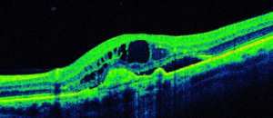 dry macular degeneration oct