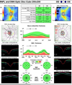 Optic nerve OCT