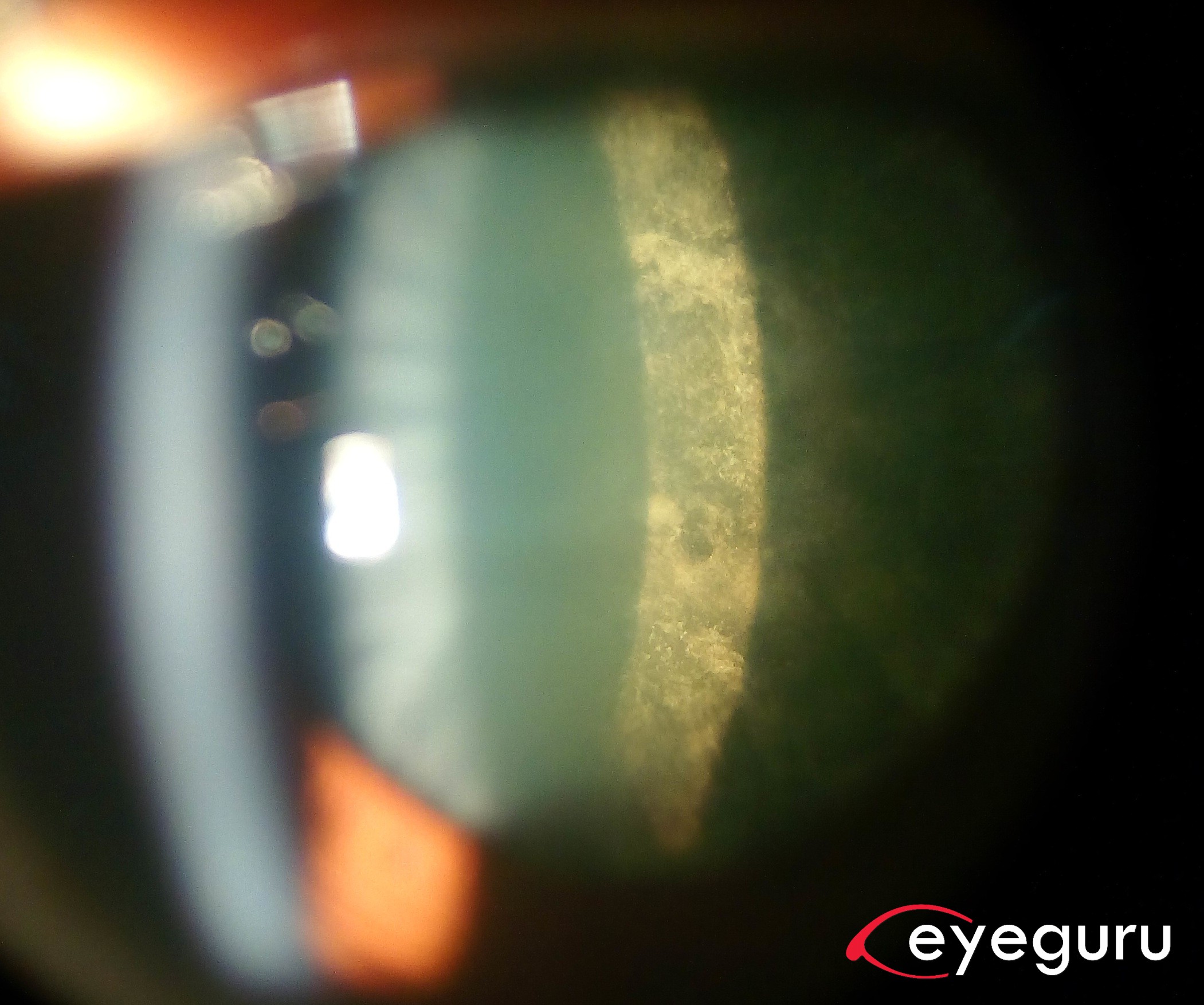 Posterior Subcapsular Cataract Eyeguru