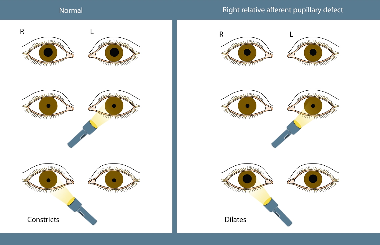 The Definitive Guide to Evaluating Pupillary Reaction: How to Measure Pupil Size and Use Neurological Tools?