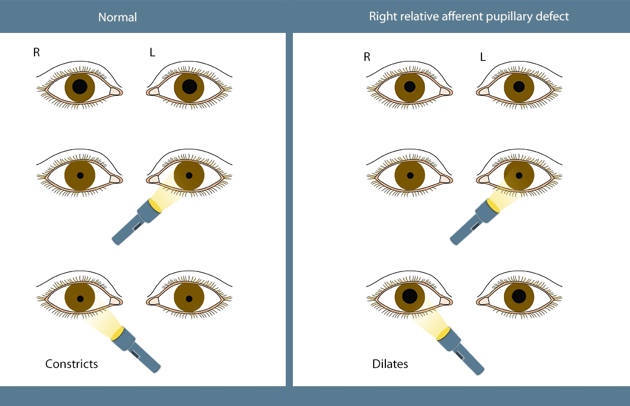 pediatric unequal pupil size