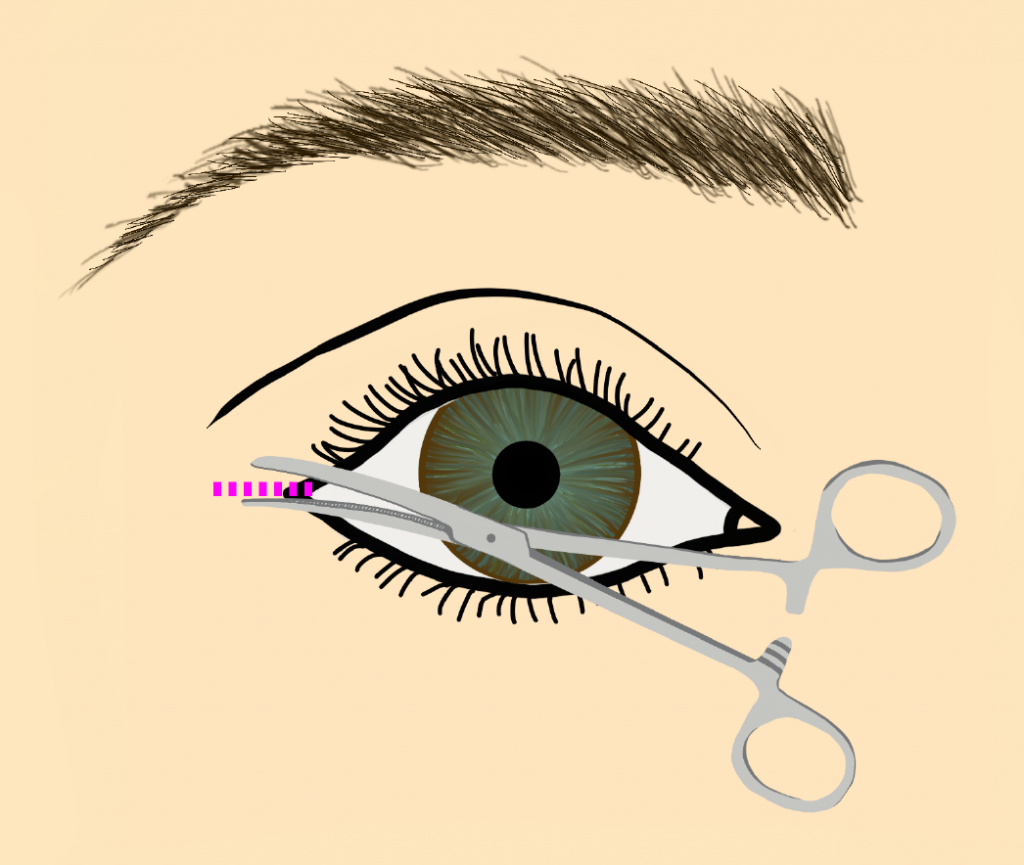 How to perform a lateral canthotomy - EyeGuru