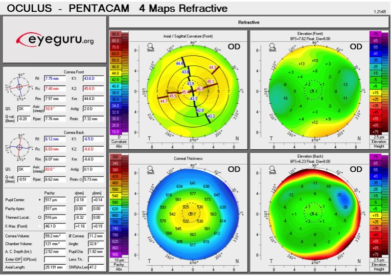 How To Interpret Corneal Topography 5 Clinical Uses Eyeguru