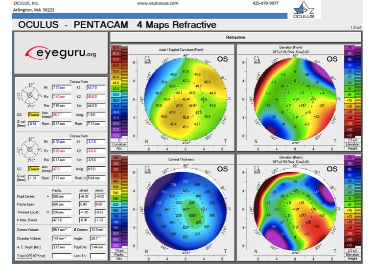 How To Interpret Corneal Topography 5 Clinical Uses Eyeguru