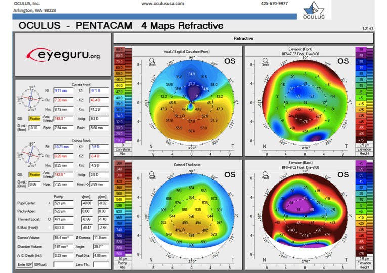 How To Interpret Corneal Topography 5 Clinical Uses Eyeguru