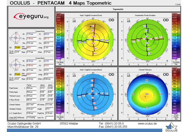 With The Rule Astigmatism Corneal Topography