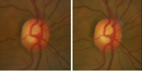 Evaluating The Cup And Disc In Glaucoma Eyeguru