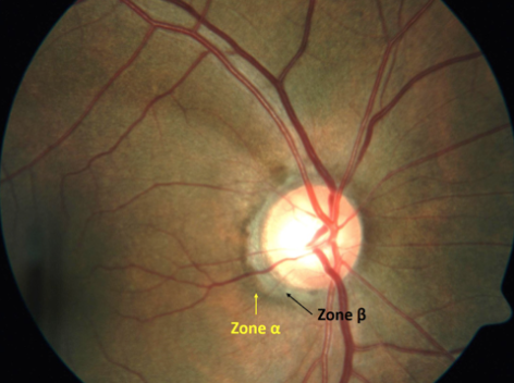 Evaluating the cup and disc in glaucoma - EyeGuru