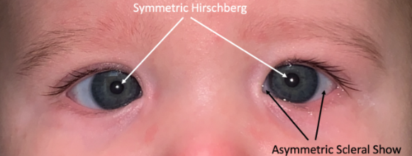 Strabismus and amblyopia