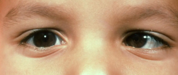 Most common types of pediatric strabismus - EyeGuru